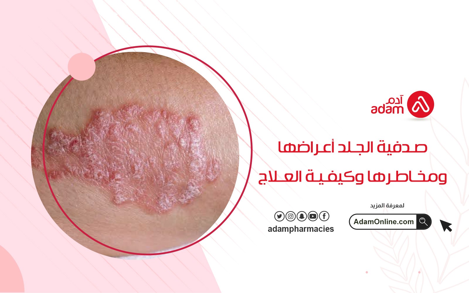 صدفية الجلد أعراضها ومخاطرها وكيفية العلاج